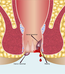 Perianal swelling